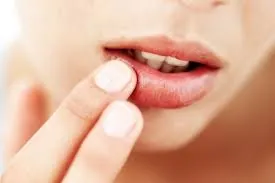 Home remedies for chapped Lips